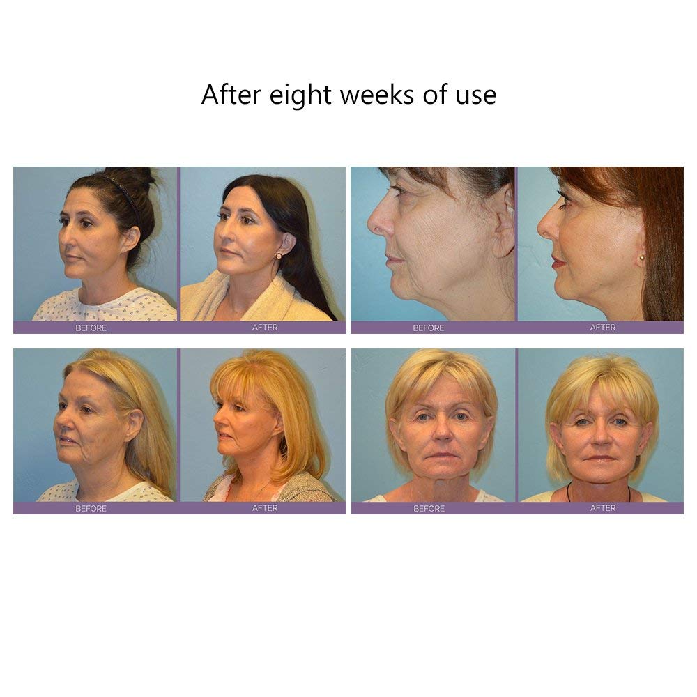 Lifting And Tightening Face-Lifting Device Facial Lifting And